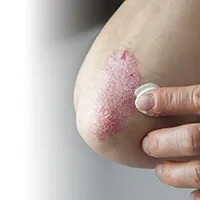 Psoriasis Larawan